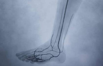 LimFlow手术患者腿部血管造影图像